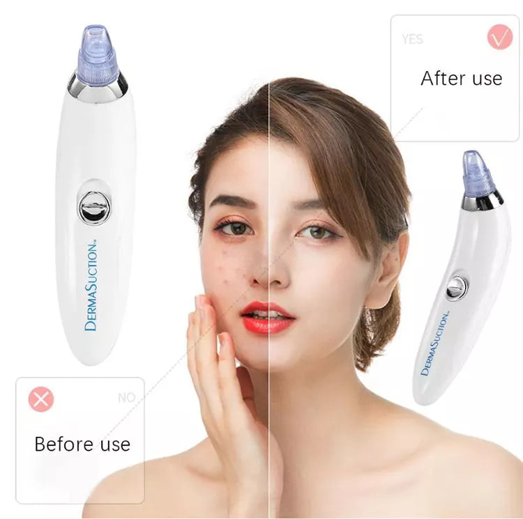 Blackhead Remover - Face Vacuum Suction