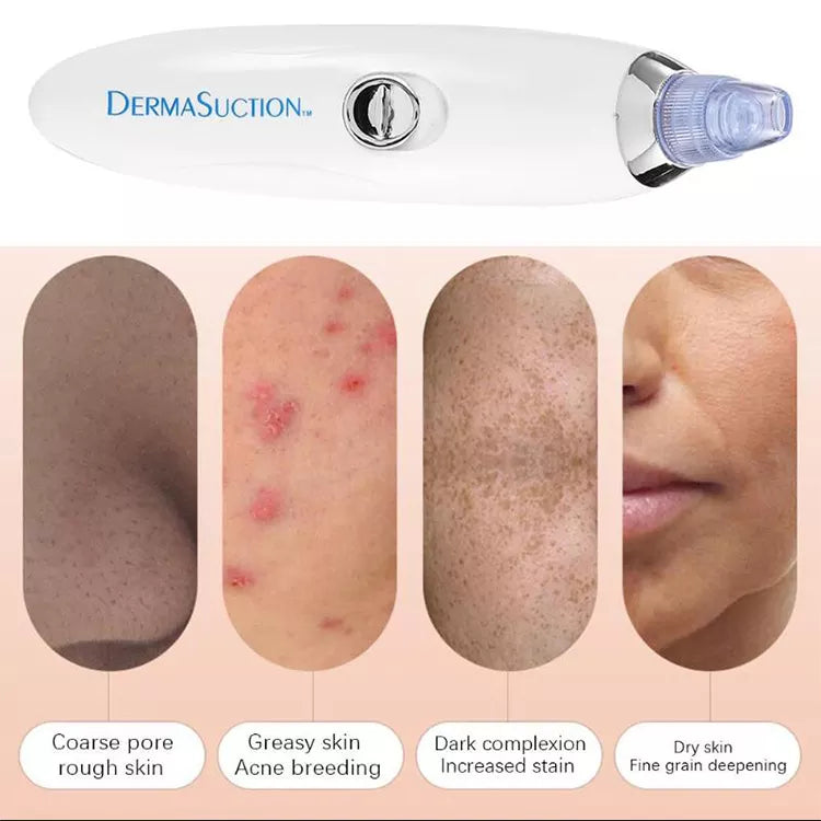 Blackhead Remover - Face Vacuum Suction